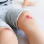 Mengapa Luka Manusia Sembuh Lebih Lama dari Hewan
