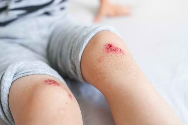 Mengapa Luka Manusia Sembuh Lebih Lama dari Hewan