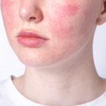 Wajah Merah Usai Makan? Waspadai Gejala Rosacea