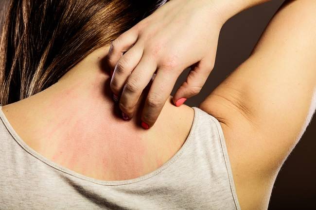 Steven Johnson Syndrome Ramai Diperbincangkan, Apa Itu?